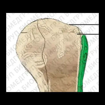 Компрессионная костная пластина плечевая кость P.R.C.T II