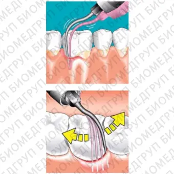 Sonicflex paro 61  длинная прямая насадка с закругленной верхушкой для минимально инвазивной терапии пародонтита