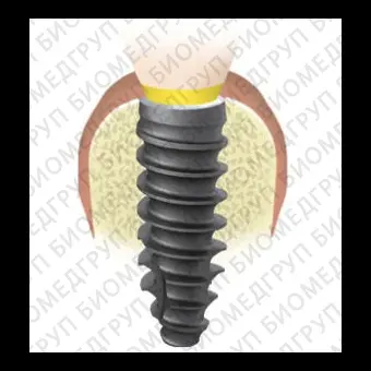 Конический зубной имплантат MasterC