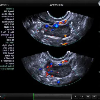 UltraSonix SonixTouch Аппарат УЗИ