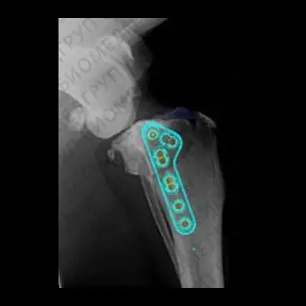 Программное обеспечение для ортопедической хирургии