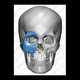 Имплантат параорбитальной области на заказ TnR PSI