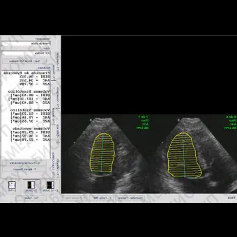Программное обеспечение для ультразвуковых исследований Ecoestres